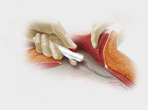 Reverdin Suture Passer Illustration
