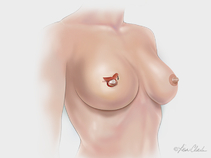 Biodesign Nipple Reconstruction Cylinder