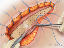 Biodesign®Incision Graft