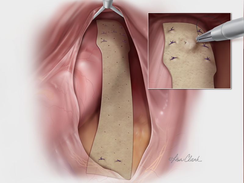 Biodesign® Rectopexy Graft | Cook Medical